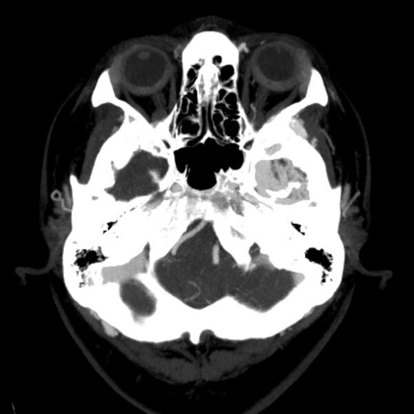 File:Cerebral arteriovenous malformation (Radiopaedia 43729-47189 B 9).jpg