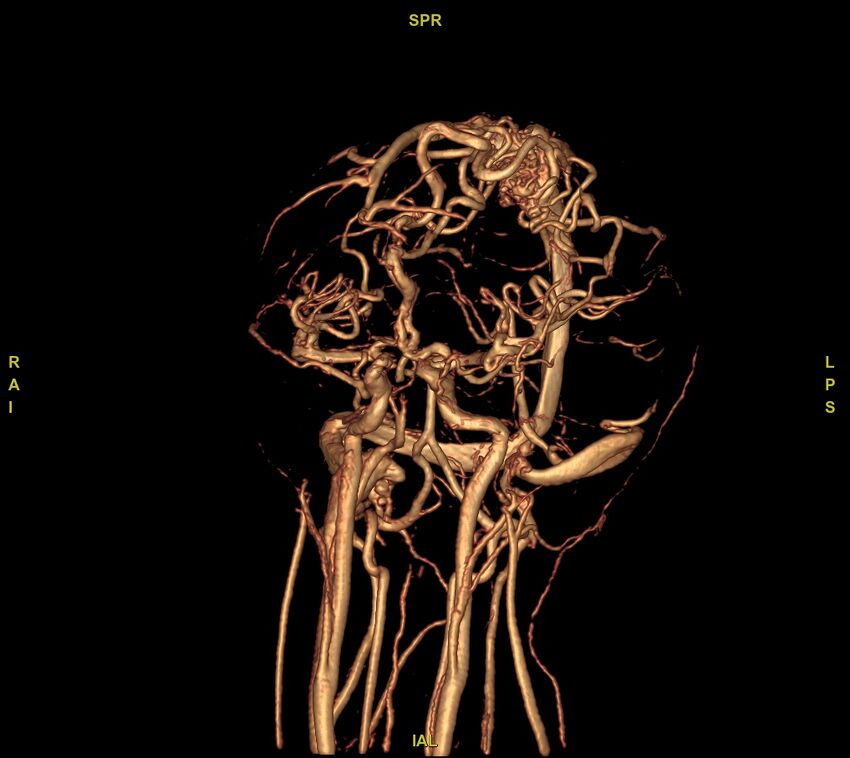 Cerebral arteriovenous malformation (Radiopaedia 61964-70029 VRT 44).jpg