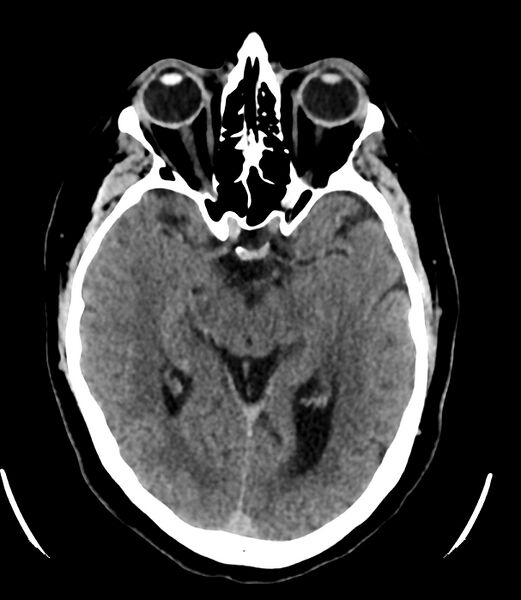 File:Cerebral dural venous sinus thrombosis (Radiopaedia 86514-102575 Axial non-contrast 19).jpg