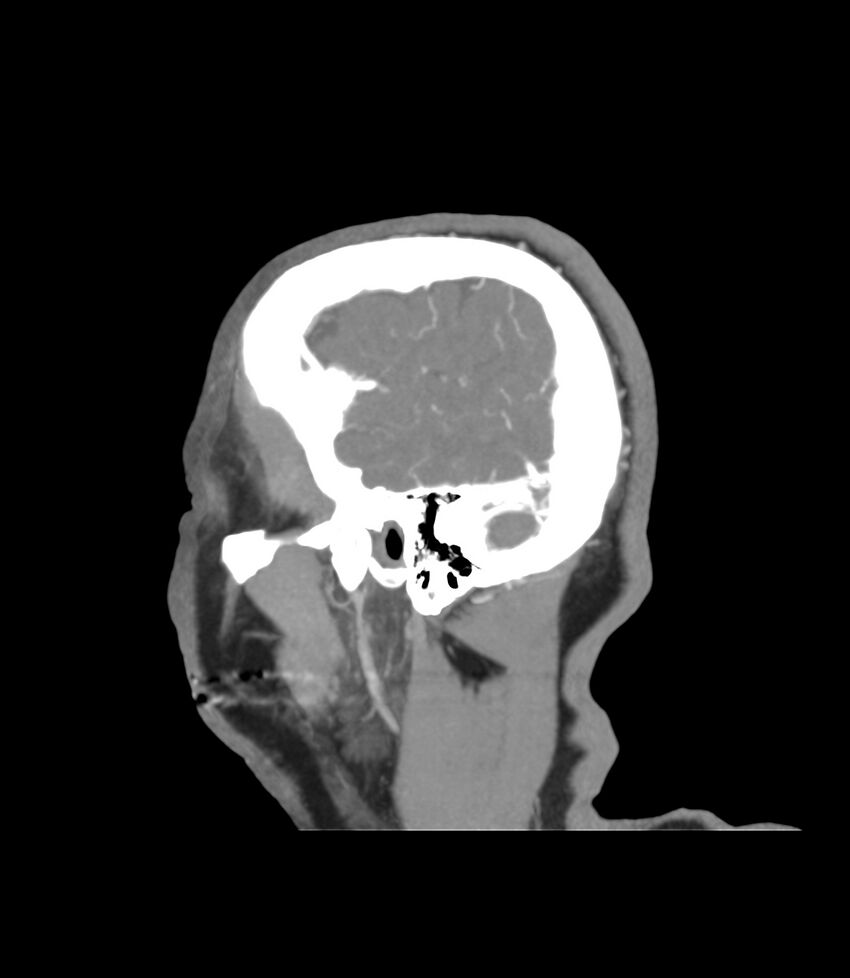 Cerebral dural venous sinus thrombosis (Radiopaedia 86514-102576 C 1).jpg