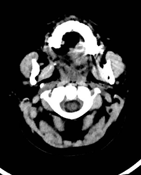 File:Cerebral edema due to severe hyponatremia (Radiopaedia 89826-106938 Axial non-contrast 4).jpg