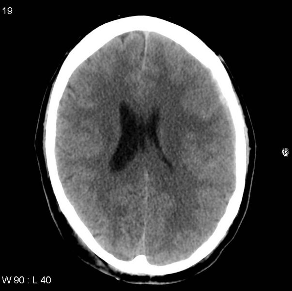 File:Cerebral hemorrhagic contusion with subdural and subarachnoid hemorrhage (Radiopaedia 10680-11146 Axial non-contrast 16).jpg