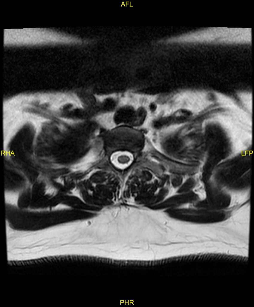 Cervical disc protrusion (Radiopaedia 87147-103415 Axial T2 86).jpg