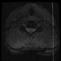 Cervical flexion teardrop fracture with cord hemorrhage (Radiopaedia 32497-33455 Axial Gradient Echo 19).jpg