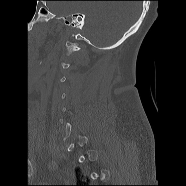 File:Cervical fracture and dislocation with locked facet (Radiopaedia 31837-32780 Sagittal bone window 3).jpg