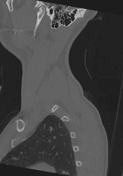 File:Cervical intercalary bone (Radiopaedia 35211-36748 Sagittal bone window 6).png