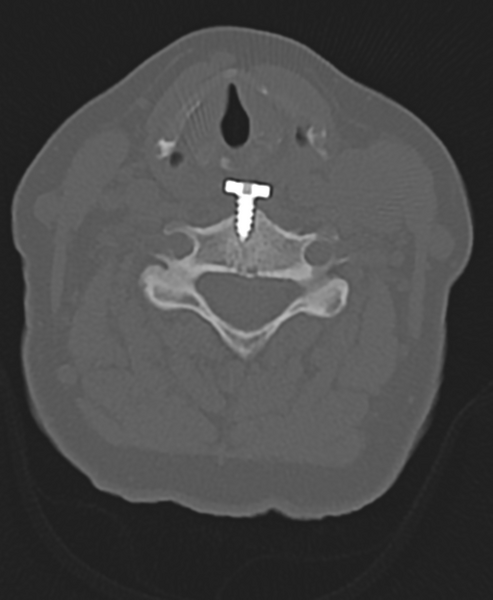 File:Cervical spine ACDF loosening (Radiopaedia 48998-54071 Axial bone window 34).png