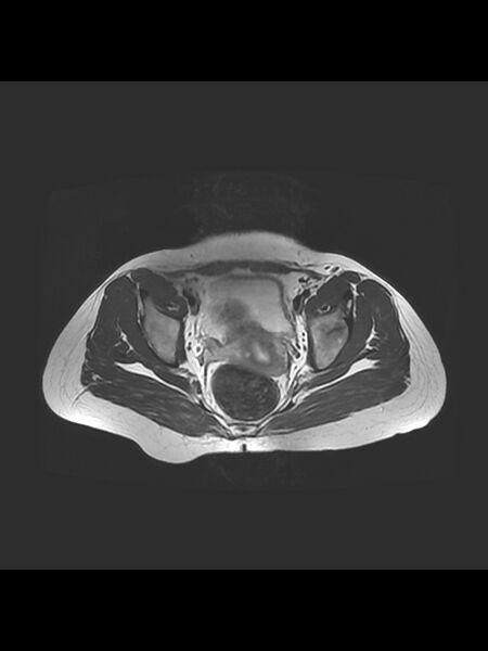 File:Cesarean section scar endometrioma (Radiopaedia 56569-63297 Axial T2 17).jpg