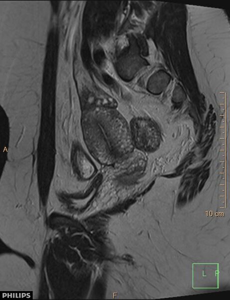 File:Cesarian scar endometriosis (Radiopaedia 68495-78066 Sagittal T2 19).jpg