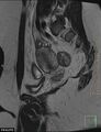 Cesarian scar endometriosis (Radiopaedia 68495-78066 Sagittal T2 19).jpg