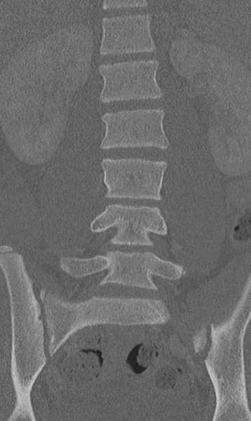 File:Chance fracture (Radiopaedia 40360-42912 Coronal bone window 30).png