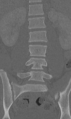 Chance fracture (Radiopaedia 40360-42912 Coronal bone window 30).png