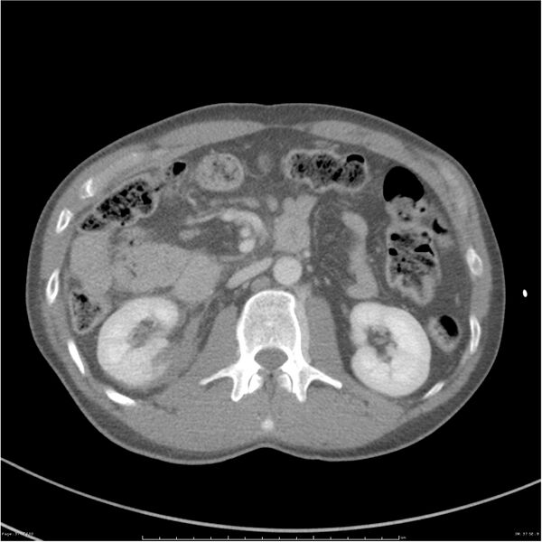 File:Chest and abdomen multi-trauma (Radiopaedia 26294-26426 bone window 37).jpg