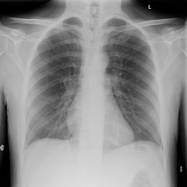 File:Chest radiograph - normal (frontal projection) (Radiopaedia 64541).png