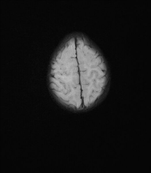 File:Chiari III malformation with occipital encephalocele (Radiopaedia 79446-92559 Axial FLAIR 22).jpg