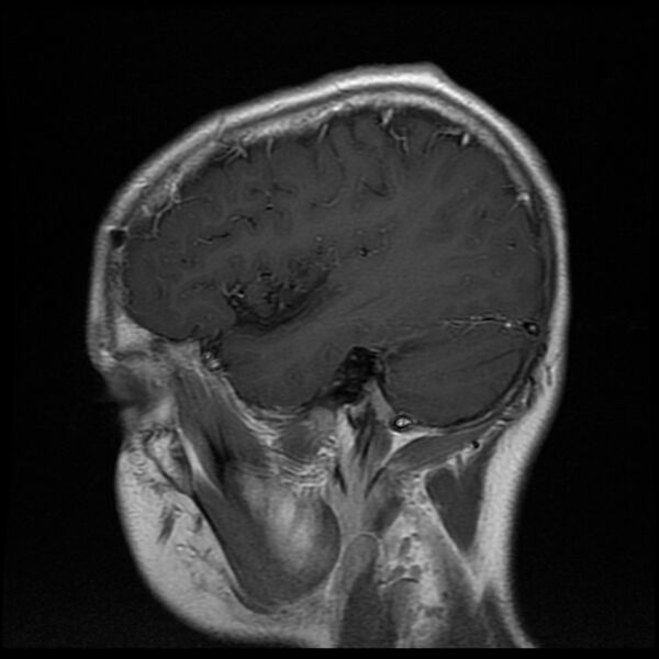 File:Chiasmatic-hypothalamic juvenile pilocytic astrocytoma (Radiopaedia 78533-91236 Sagittal T1 C+ 6).jpg