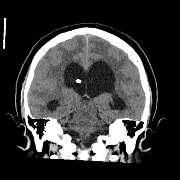 File:Chiasmatic-hypothalamic juvenile pilocytic astrocytoma (Radiopaedia 78533-91237 Coronal non-contrast 42).jpg