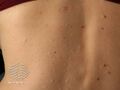 Chickenpox scars (DermNet NZ dermal-infiltrative-s-anetoderma01).jpg