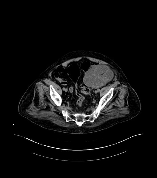 File:Cholangiocarcinoma with cerebral metastases (Radiopaedia 83519-98629 Axial non-contrast 105).jpg