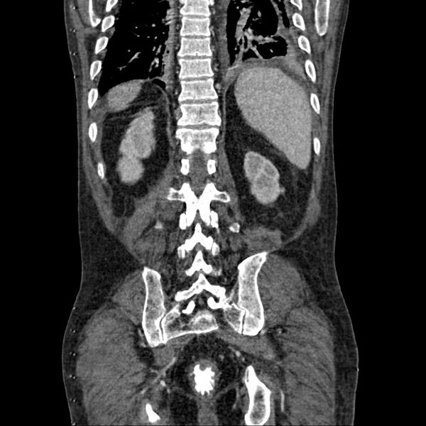 File:Cholangitis and abscess formation in a patient with cholangiocarcinoma (Radiopaedia 21194-21100 C 16).jpg
