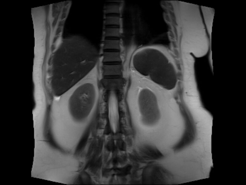 File:Choledocholithiasis causing intrahepatic biliary duct dilation (Radiopaedia 39908-42369 Coronal T2 20).jpg