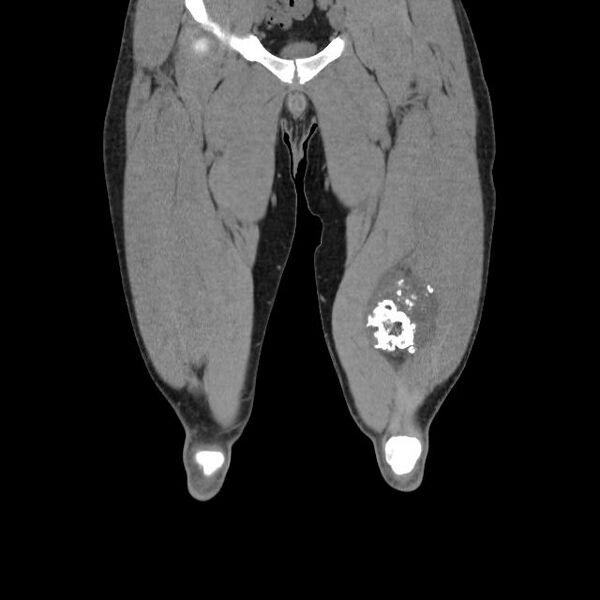 File:Chondrosarcoma arising from exostosis (Radiopaedia 59996-67507 Coronal soft tissue 6).jpg