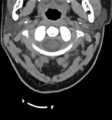 Chordoma (C4 vertebra) (Radiopaedia 47561-52188 Axial non-contrast 10).png