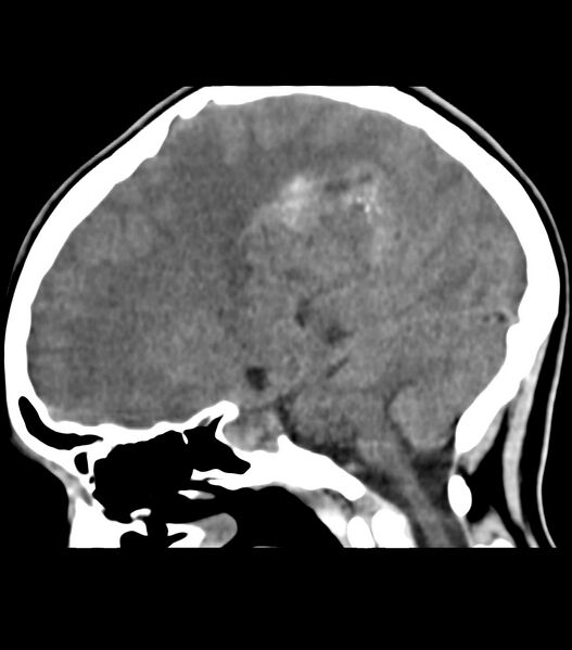File:Choroid plexus carcinoma (Radiopaedia 91013-108552 B 42).jpg