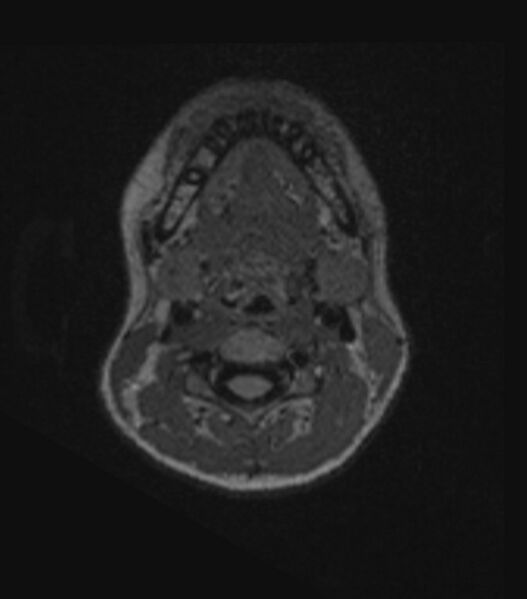File:Choroid plexus carcinoma (Radiopaedia 91013-108553 Axial FLAIR C+ 24).jpg