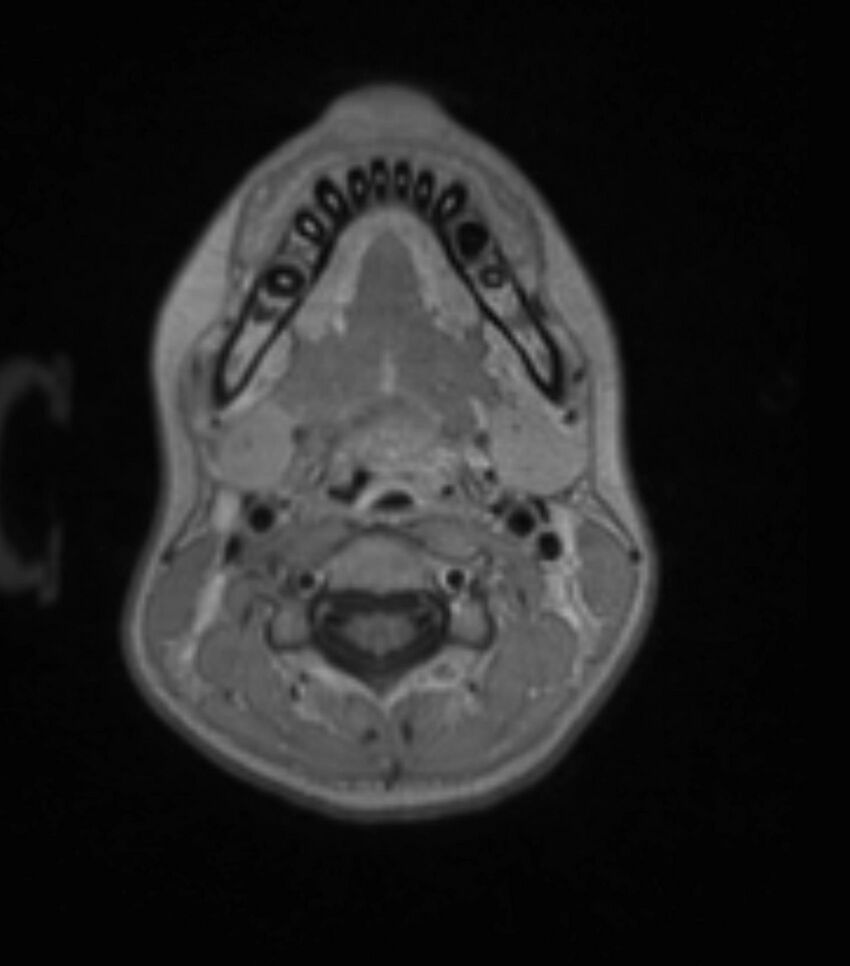 Choroid plexus carcinoma (Radiopaedia 91013-108553 Axial T1 C+ 27).jpg