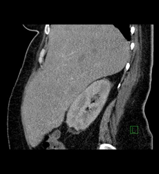 File:Chromophobe renal cell carcinoma (Radiopaedia 84239-99519 D 87).jpg