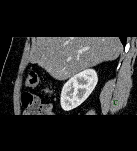 File:Chromophobe renal cell carcinoma (Radiopaedia 84286-99573 F 130).jpg