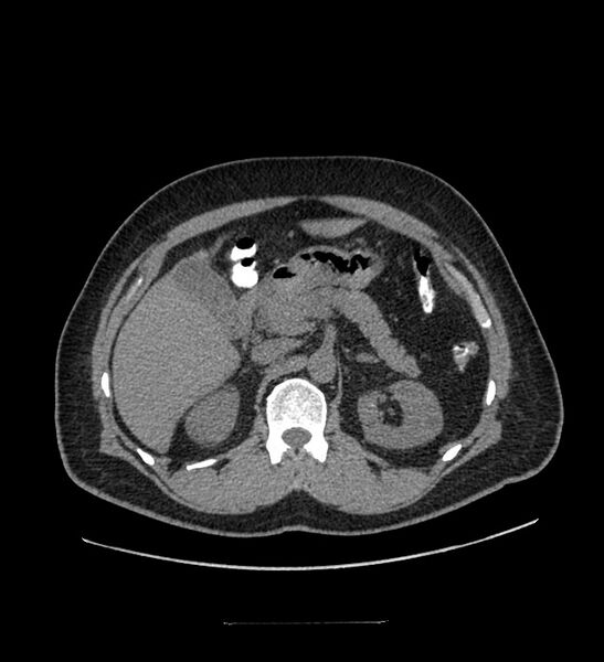File:Chromophobe renal cell carcinoma (Radiopaedia 84337-99644 Axial non-contrast 32).jpg