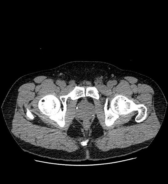 File:Chromophobe renal cell carcinoma (Radiopaedia 84337-99693 Axial non-contrast 160).jpg