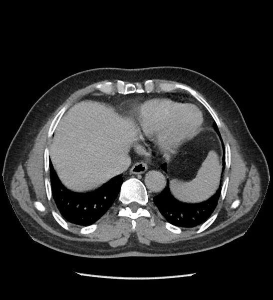 File:Chromophobe renal cell carcinoma (Radiopaedia 86879-103083 D 9).jpg