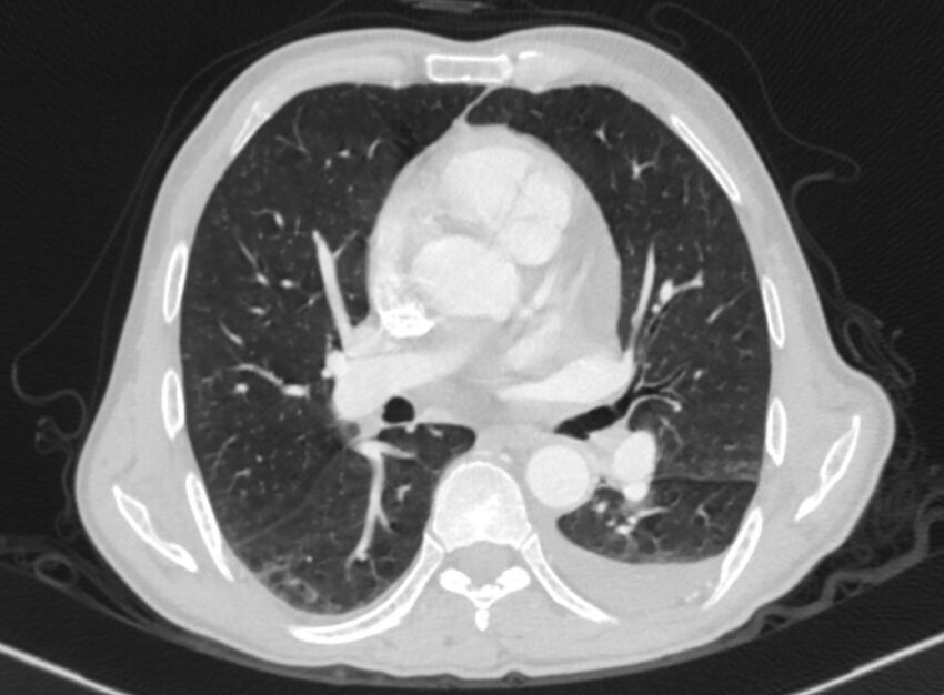Chronic pulmonary embolism with bubbly consolidation (Radiopaedia 91248-108850 Axial lung window 83).jpg