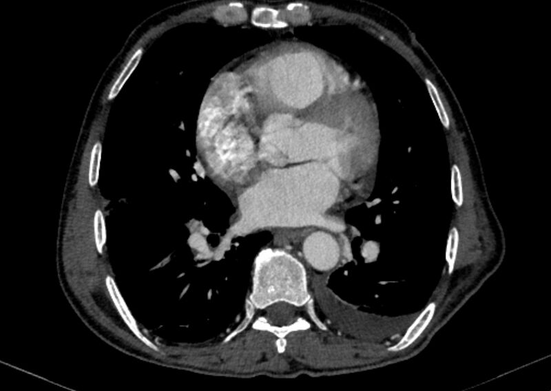 File:Chronic pulmonary embolism with bubbly consolidation (Radiopaedia 91248-108850 C+ arterial phase 92).jpg