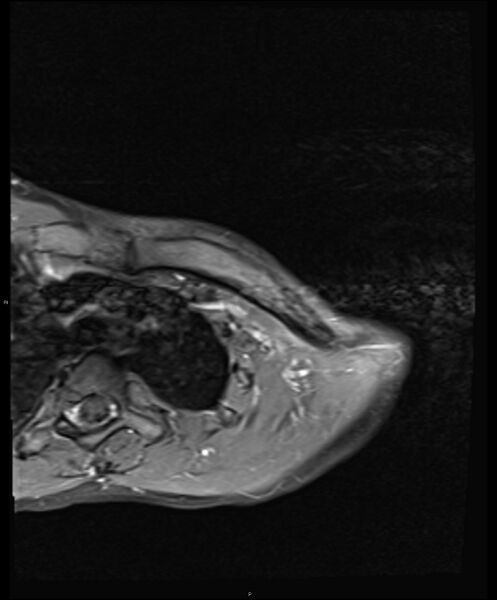 File:Chronic reactive multifocal osteomyelitis (CRMO) - clavicle (Radiopaedia 56406-63114 Axial T1 C+ fat sat 7).jpg