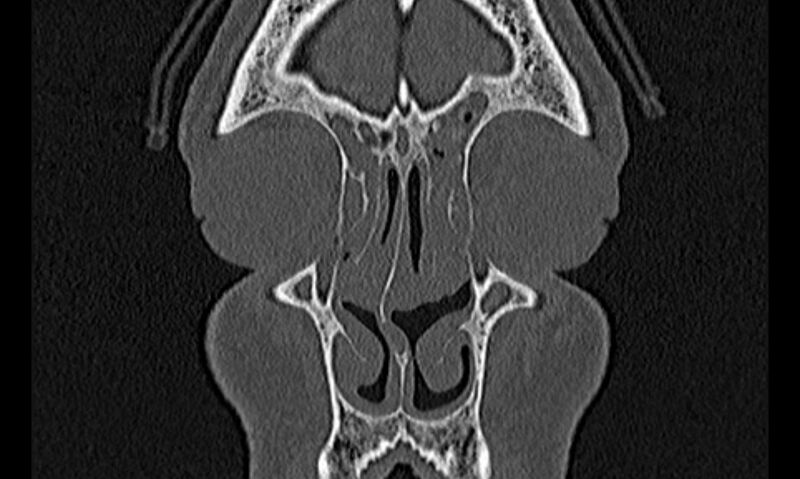 File:Chronic rhinosinusitis (Radiopaedia 65079-74075 Coronal bone window 14).jpg