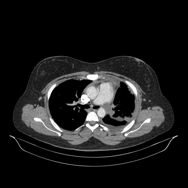 File:Chronic thromboembolic pulmonary hypertension (CTEPH) (Radiopaedia 74597-85532 Axial C+ CTPA 102).jpg