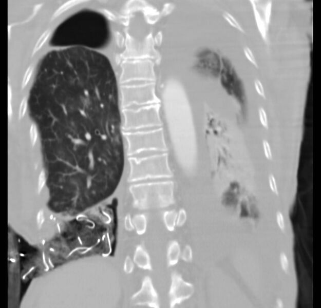 File:Clagett thoracotomy with bronchopleural fistula (Radiopaedia 29192-29587 Coronal lung window 7).jpg