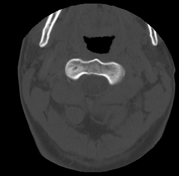 File:Clay-shoveler fracture (Radiopaedia 22568-22590 Axial bone window 16).jpg