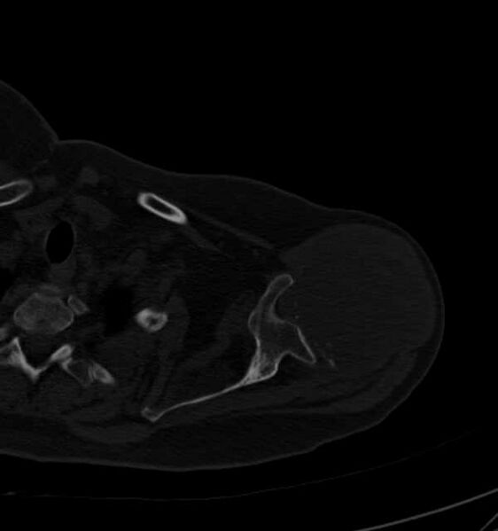 File:Clear cell chondrosarcoma - humerus (Radiopaedia 63104-71612 Axial bone window 28).jpg