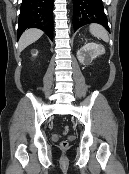 File:Clear cell renal cell carcinoma (Radiopaedia 61449-69393 F 38).jpg