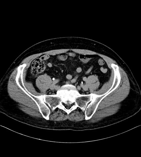 File:Clear cell renal cell carcinoma (Radiopaedia 85006-100539 H 45).jpg