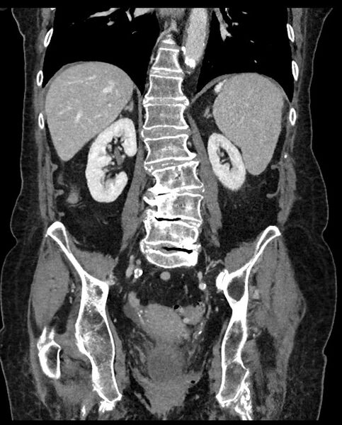 File:Closed loop small bowel obstruction - adhesions (Radiopaedia 59269-66611 B 81).jpg