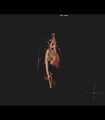 Coarctation of the aorta (Radiopaedia 43373-46729 3D reconstruction 33).jpg