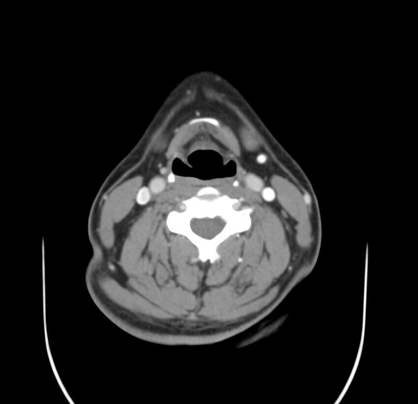 Colloid cyst of thyroid (Radiopaedia 22897-22923 Axial C+ delayed 41).jpg
