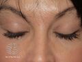 Effect of bimatoprost solution on eyelashes (DermNet NZ treatments-bimatoprost01).jpg