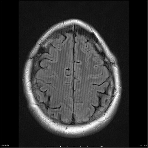 File:Herringbone MRI artifact (Radiopaedia 19695).jpg